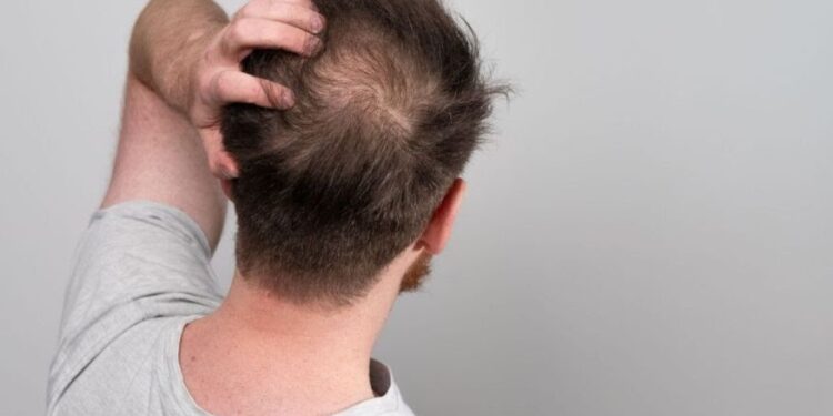 Queda de cabelo: conheça as principais causas e o que fazer