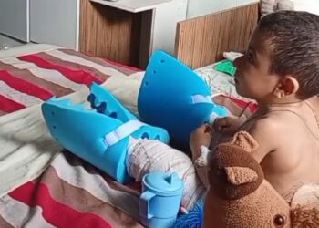 Menino de 3 anos com doença dos ‘ossos de vidro’ passa pela 1ª cirurgia reparadora via SUS na BA: ‘Oportunidade de vida normal’, diz pai