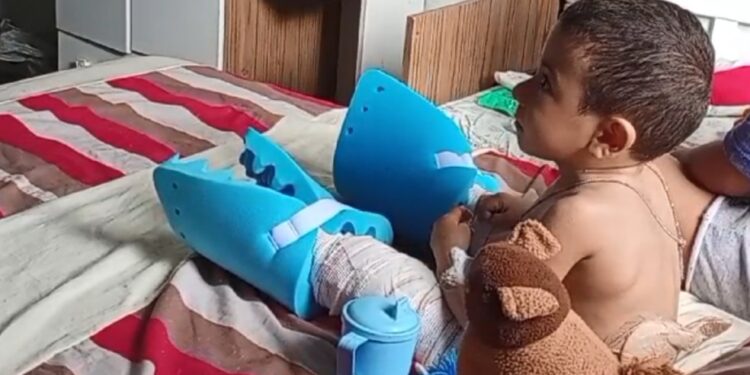 Menino de 3 anos com doença dos ‘ossos de vidro’ passa pela 1ª cirurgia reparadora via SUS na BA: ‘Oportunidade de vida normal’, diz pai