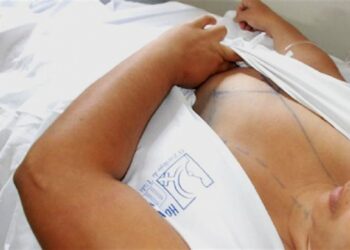 Fundação Hospitalar divulga resultado da primeira etapa do Programa de Tratamento de Gigantomastias