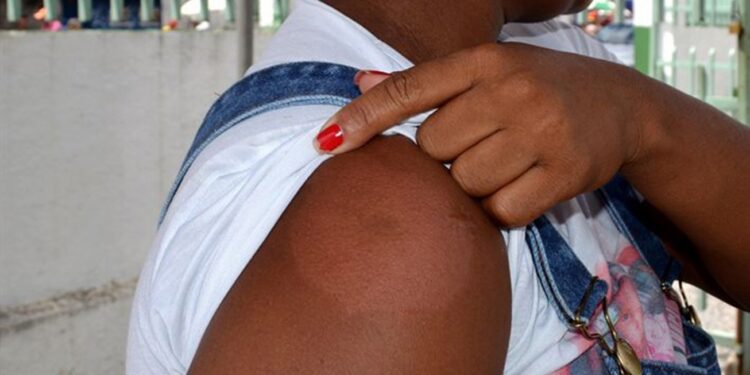 Janeiro Roxo reforça combate à hanseníase em Feira de Santana