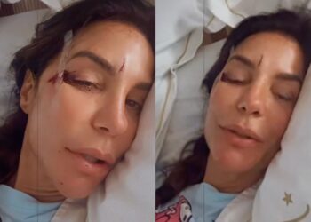 Ivete Sangalo surge em hospital com machucados no rosto e relata susto: ‘Desmaiei