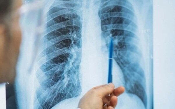 Secretaria de Saúde promove programação especial pelo Dia Mundial de Combate à Tuberculose