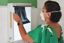 Dia Mundial de Combate à Tuberculose: pneumologista alerta para diagnóstico precoce e risco de abandono do tratamento