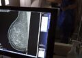 Carreta oferece mamografias gratuitas em Feira de Santana, Jequié e Alagoinhas; saiba como agendar